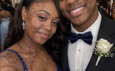 A Boy Asked Me to Dance at Prom Because No One Else Would Due to My Scars – The Next Day, His Parents and Officers Showed up at My Door