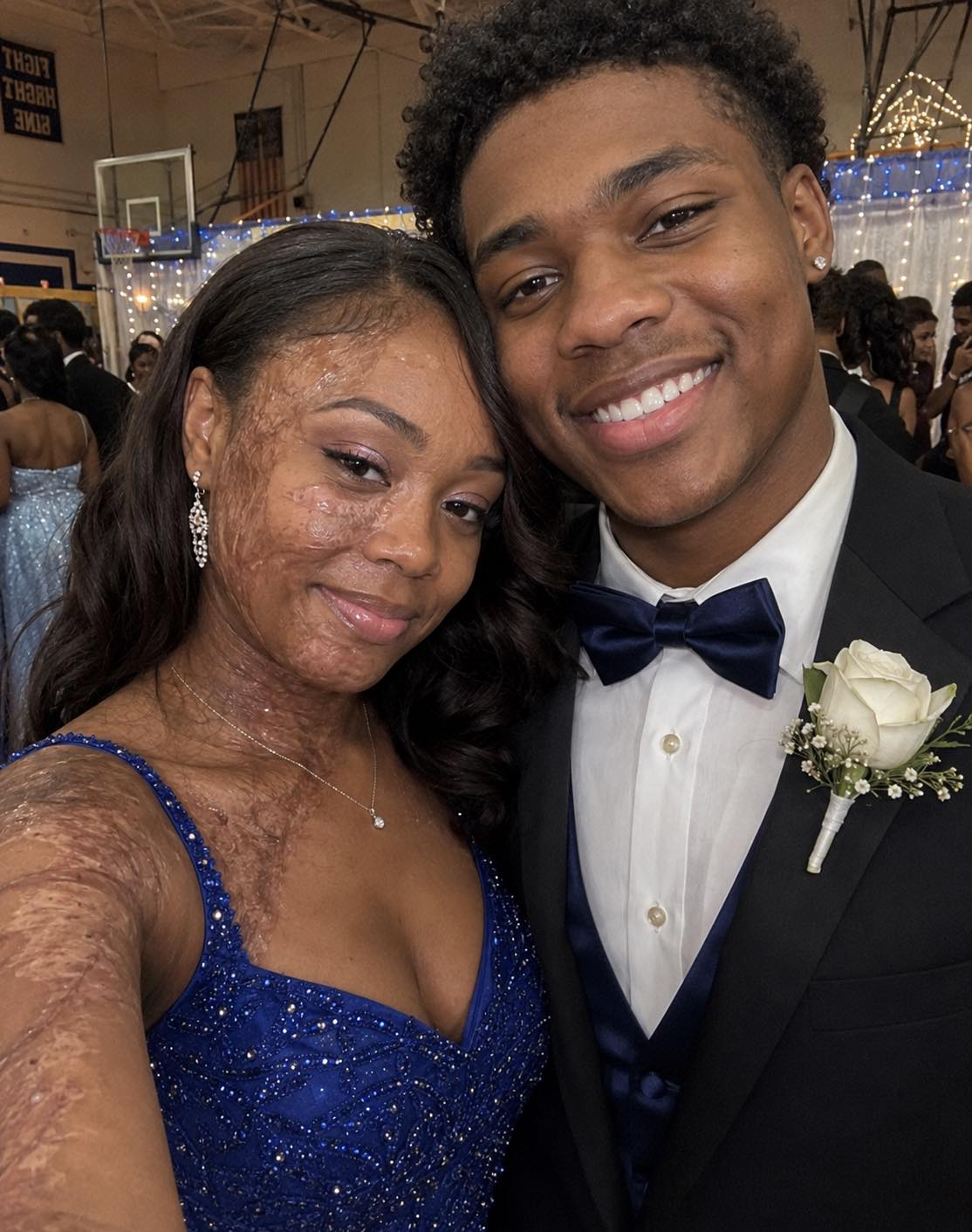 A Boy Asked Me to Dance at Prom Because No One Else Would Due to My Scars – The Next Day, His Parents and Officers Showed up at My Door