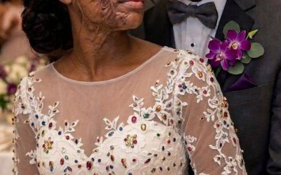 I Married a Blind Man So He’d Never See My Scars – On Our Wedding Night, He Said, ‘You Need to Know the Truth I’ve Been Hiding for 20 Years’