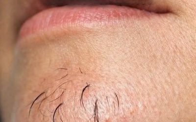 Why Chin Hair Grows in Women and What It May Indicate 0